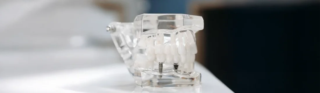 3D Guided Implant Surgery in Mill Creek WA 3D Guided Implant Surgery in Mill Creek WA