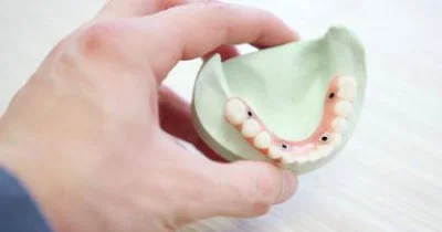 Dentist Mill Creek WA All-on-X Implant Model A photo of a mouth model indicating where implants would be placed