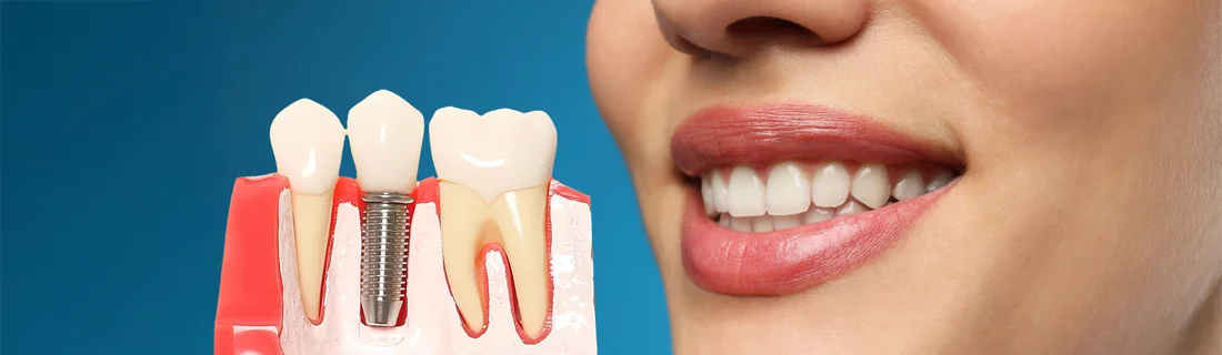 Immediate Implants in Mill Creek WA Immediate Implants in Mill Creek WA