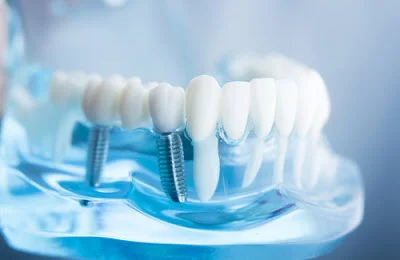 Dentist Mill Creek WA Implants Model A mouth model with transparent gums to show what implants look like when installed