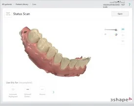 Dentist Mill Creek WA Intraoral Scanner A computerized 3D model of a patient's mouth with use of the Intraoral scanner