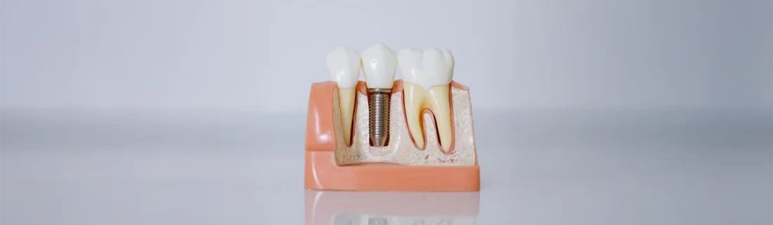 Surgical Dental Implants in Mill Creek WA Surgical Dental Implants in Mill Creek WA